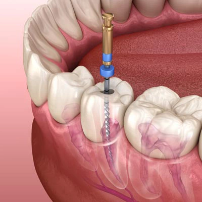 root canal diagram